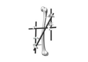 Multipurpose External Fixation System For Serious Backbone Fractures