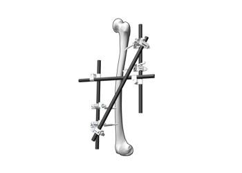 Cheap Multipurpose External Fixation System For Serious Backbone Fractures for sale