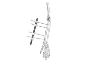 Ulna And Radius External Fixator Fracture Reduction Stable Fixation Adjustable