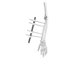 Cheap Ulna And Radius External Fixator Fracture Reduction Stable Fixation Adjustable for sale