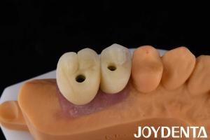 China Porcelain Implant Crown and Bridge The Ultimate Solution for Restoration Of Missing Teeth on sale