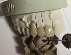 CAD Technique ISO13485 Interim Crown