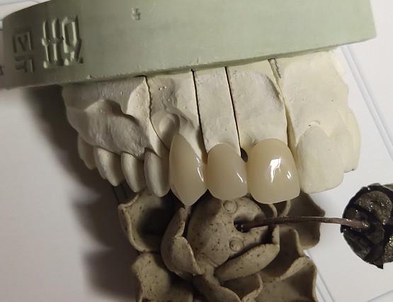 Cheap CAD Technique ISO13485 Interim Crown for sale