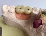 Temporary PMMA Temporary Crown