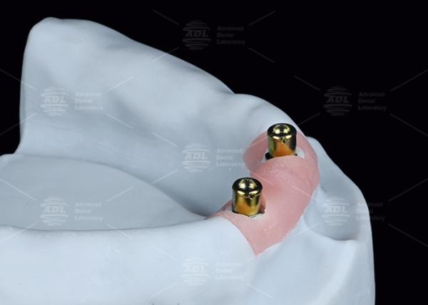 Cheap Overdenture Locator Attachments Titanium Bracket Locator Denture Attachments for sale