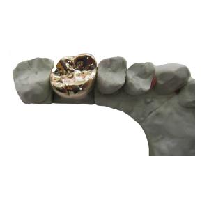 Best Full Metal PFM Dental Crown Bridge High Tech Biological Material wholesale