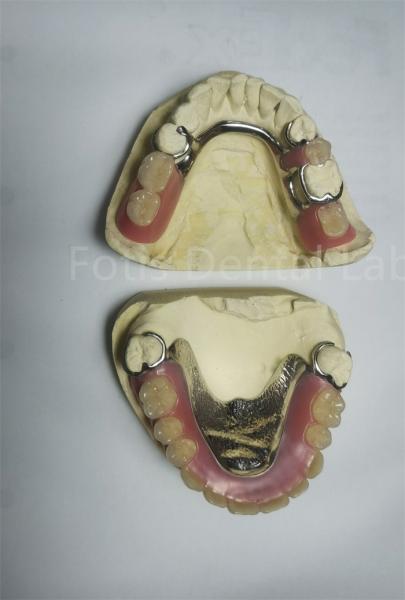 Cheap PEEK Upper Removable Partial Denture Requires Regular Maintenance for sale
