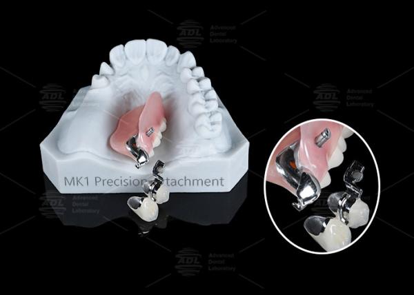 Cheap MK1 Precision Attachment Removable Partial Denture Easy Installation for sale