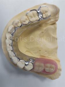 Replace Missing Teeth Removable Partial Denture Dental Prosthesis Flexible Design