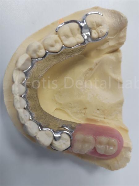 Cheap Replace Missing Teeth Removable Partial Denture Dental Prosthesis Flexible Design for sale