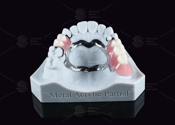 Cheap Removable Metal Acrylic Partial Denture With Clasps For Partial Chewing for sale