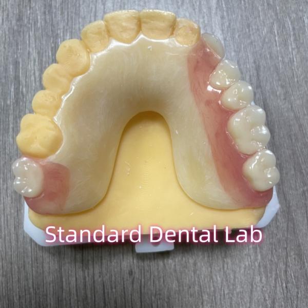 Cheap OEM Removable Cast Tooth Shade Acrylic Partial Denture With Clasps for sale