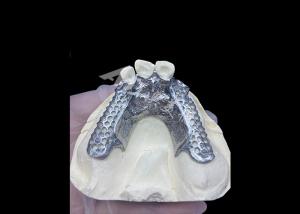 Easy Fit Custom Cast Partial Denture Stable and Natural-looking Framework for Fast Results