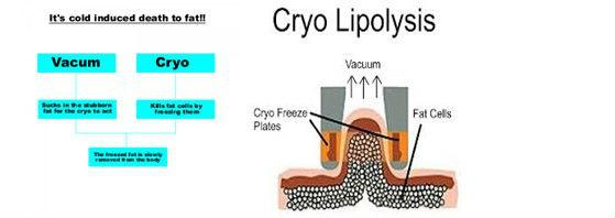 Cryolipolysis fat freeze slimming machine body shaping freeze fat machine