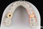 Flexible Denture Finish Personalized Customization and Advanced Tooth Arrangemen