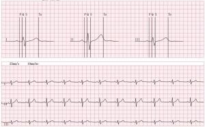 Telemetry Bluetooth EKG Check Recorder ECG Loop Recorder Android/IOS System Supported