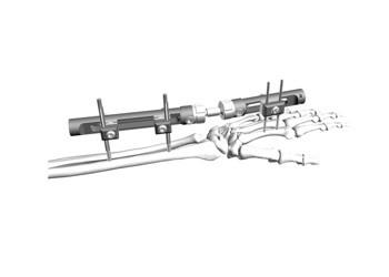 Cheap Distal Radius External Fixation System Minimal Interference With Soft Tissue Cover for sale