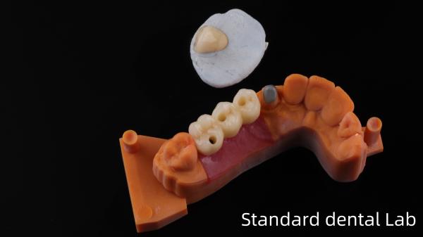 Cheap Post Core Dental Lab from China / Metal Post Core with PFM Crown for sale