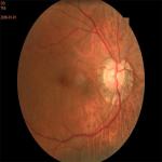 Autoexposure Automated Fundus Camera FFA Non Mydriatic