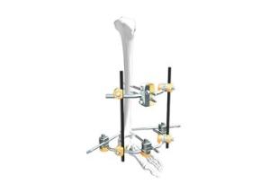 Children’S Femur Spanning External Fixation System In Fracture Treatment