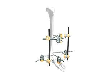 Cheap Children’S Femur Spanning External Fixation System In Fracture Treatment for sale