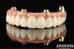 Functionality Ti-Bar Compatible With Natural Teeth And Gums Restores Chewing