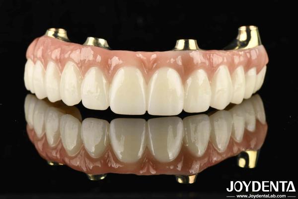 Functionality Ti-Bar Compatible With Natural Teeth And Gums Restores Chewing