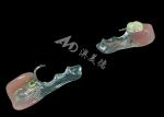 Customized Cast Partial Dentures Precision Metal Framework For Optimal Fit And